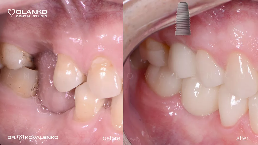 Ситуация после установки коронки до и после Оланко Бровары Киев