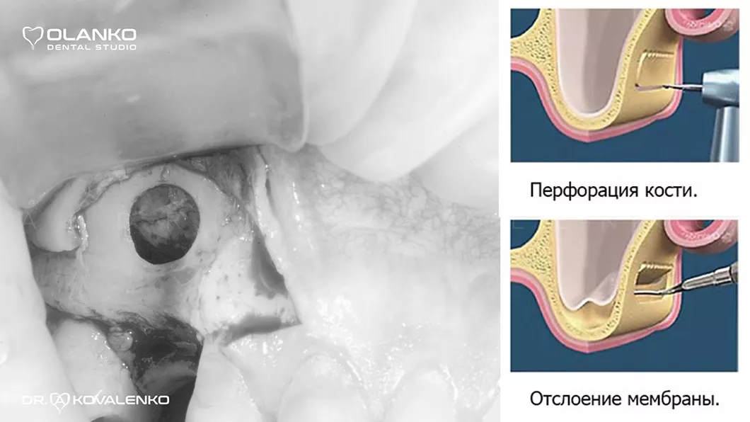 Наращивание костной ткани на нижней челюсти Оланко Бровары Киев