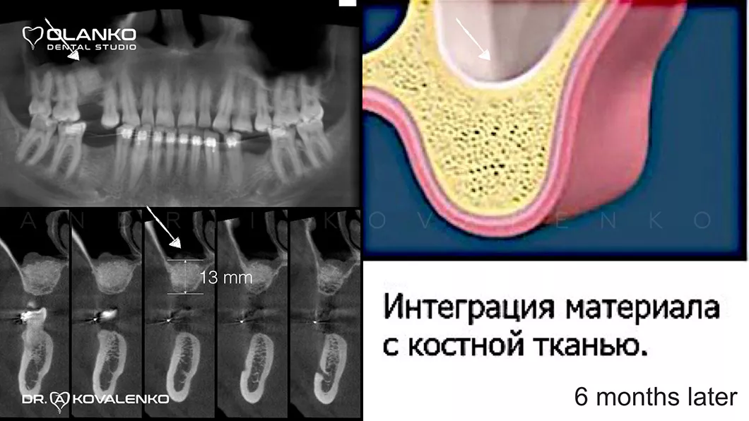 Наращивание костной ткани челюсти Оланко Бровары Киев