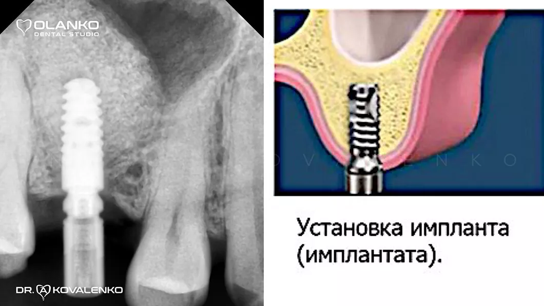 Установка имплантата после наращивание костной ткани Оланко Бровары Киев
