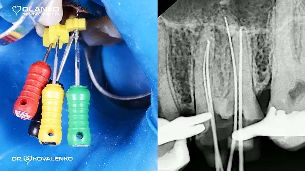 Рентген контроль длины каналов с инструментами Киев Бровары Оланко