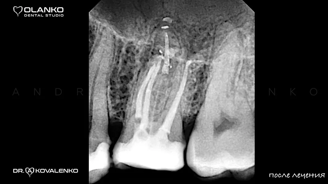 Пломбировка (3D обтурация корневых каналов) горячей гуттаперчей Киев Бровары Оланко