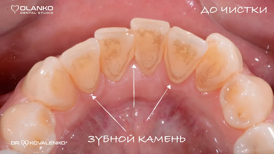 До шлифовки и полировки поверхности зубов