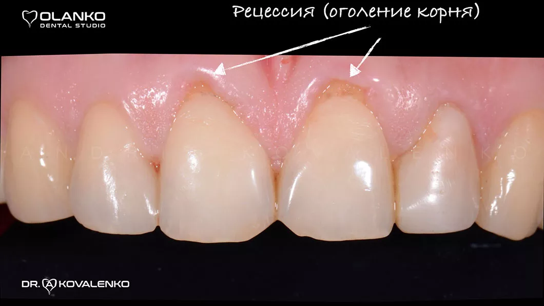 Десневая пластика цена Оланко Бровары Киев