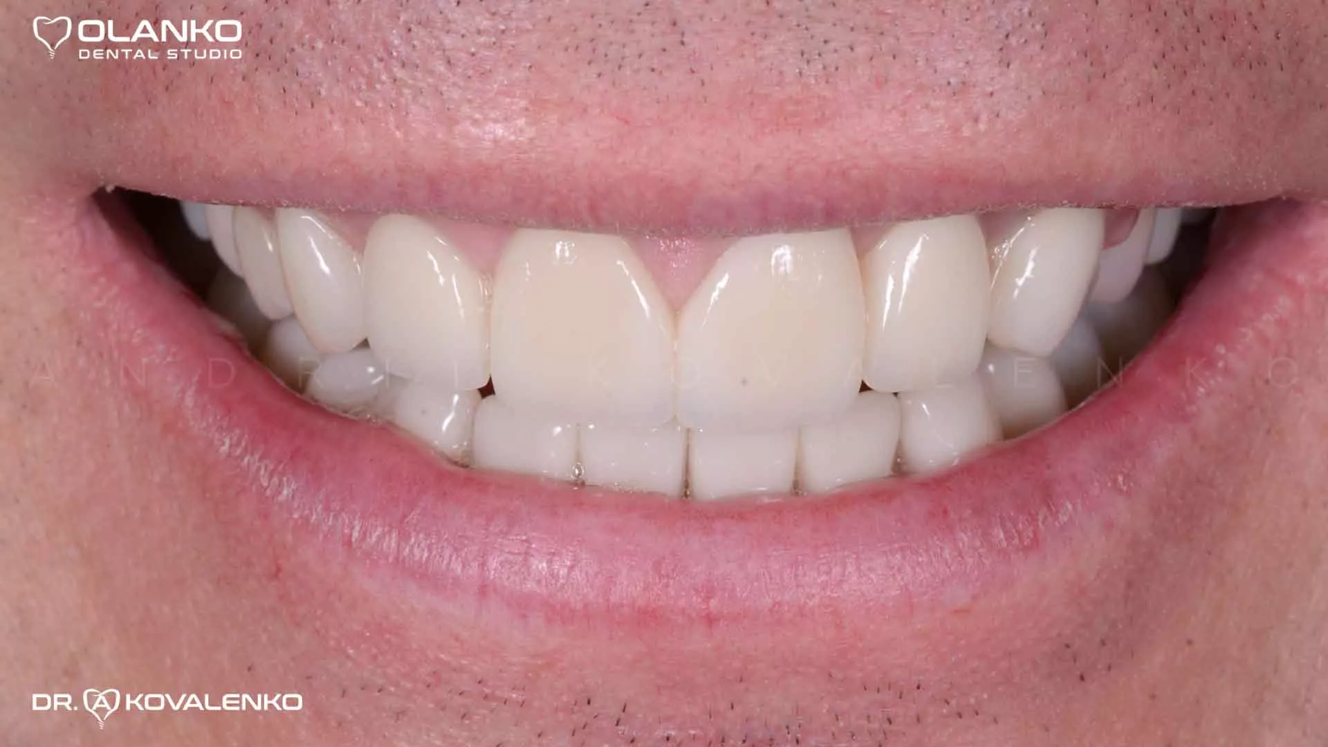 Клинический случай 5 Керамические виниры(коронки)