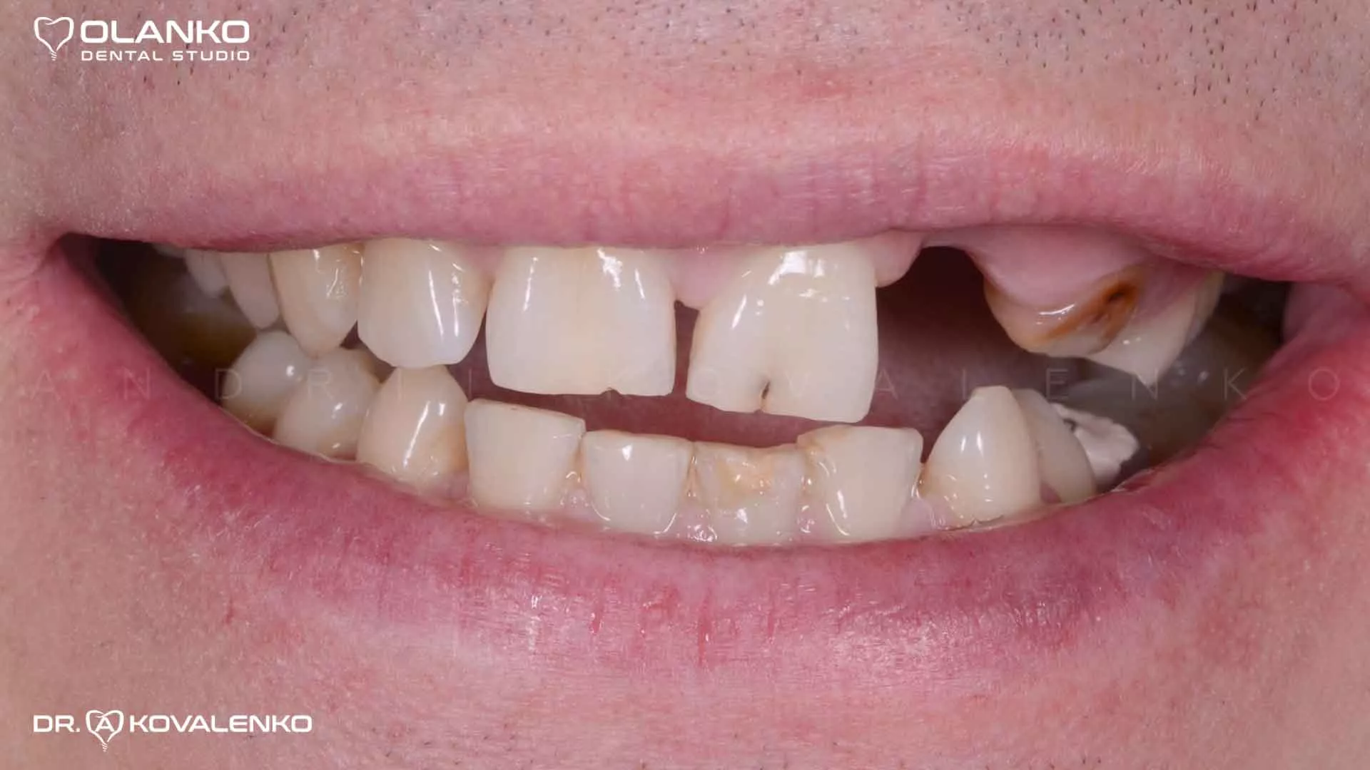 Клинический случай 5 Керамические виниры(коронки)