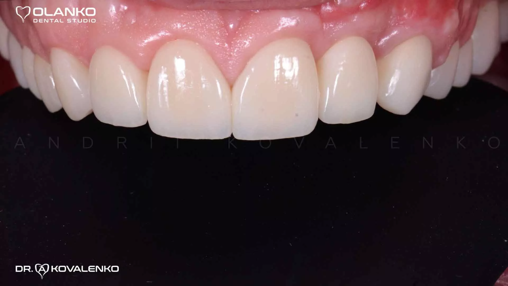 Клинический случай 5 Керамические виниры(коронки)