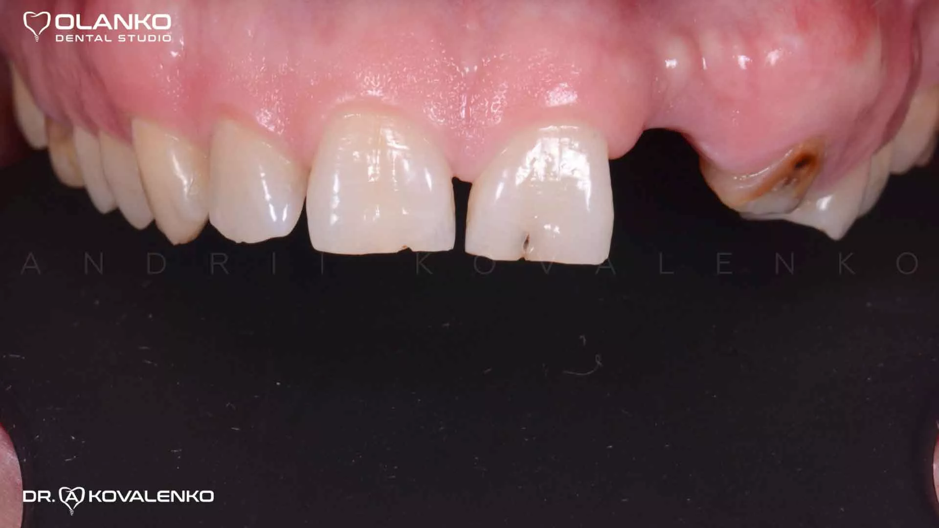 Клинический случай 5 Керамические виниры(коронки)