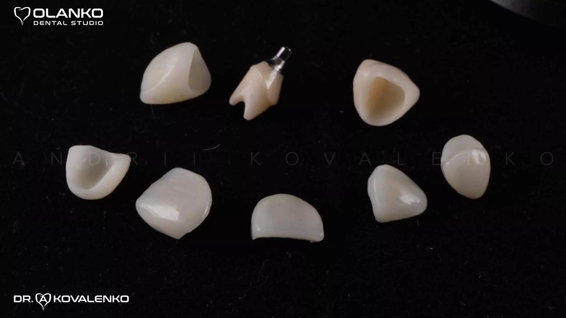 Клинический случай 5 Керамические виниры(коронки)