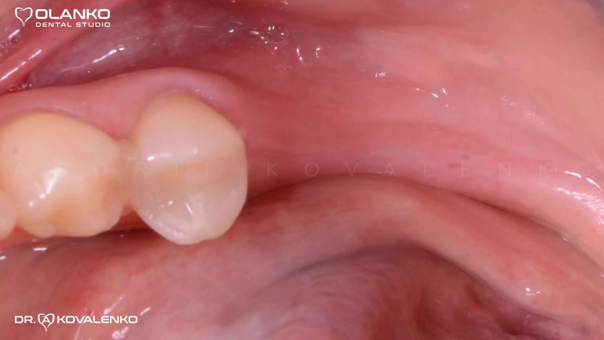 Клинический случай 6 имплантация зубов