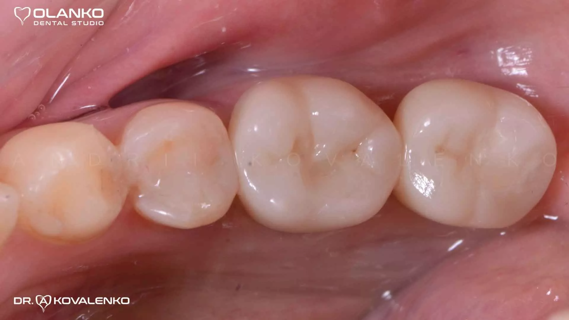 Клинический случай 6 имплантация зубов