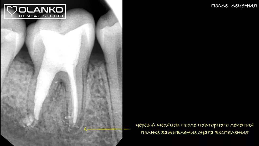 Лечение Периодонтита Киев Бровары