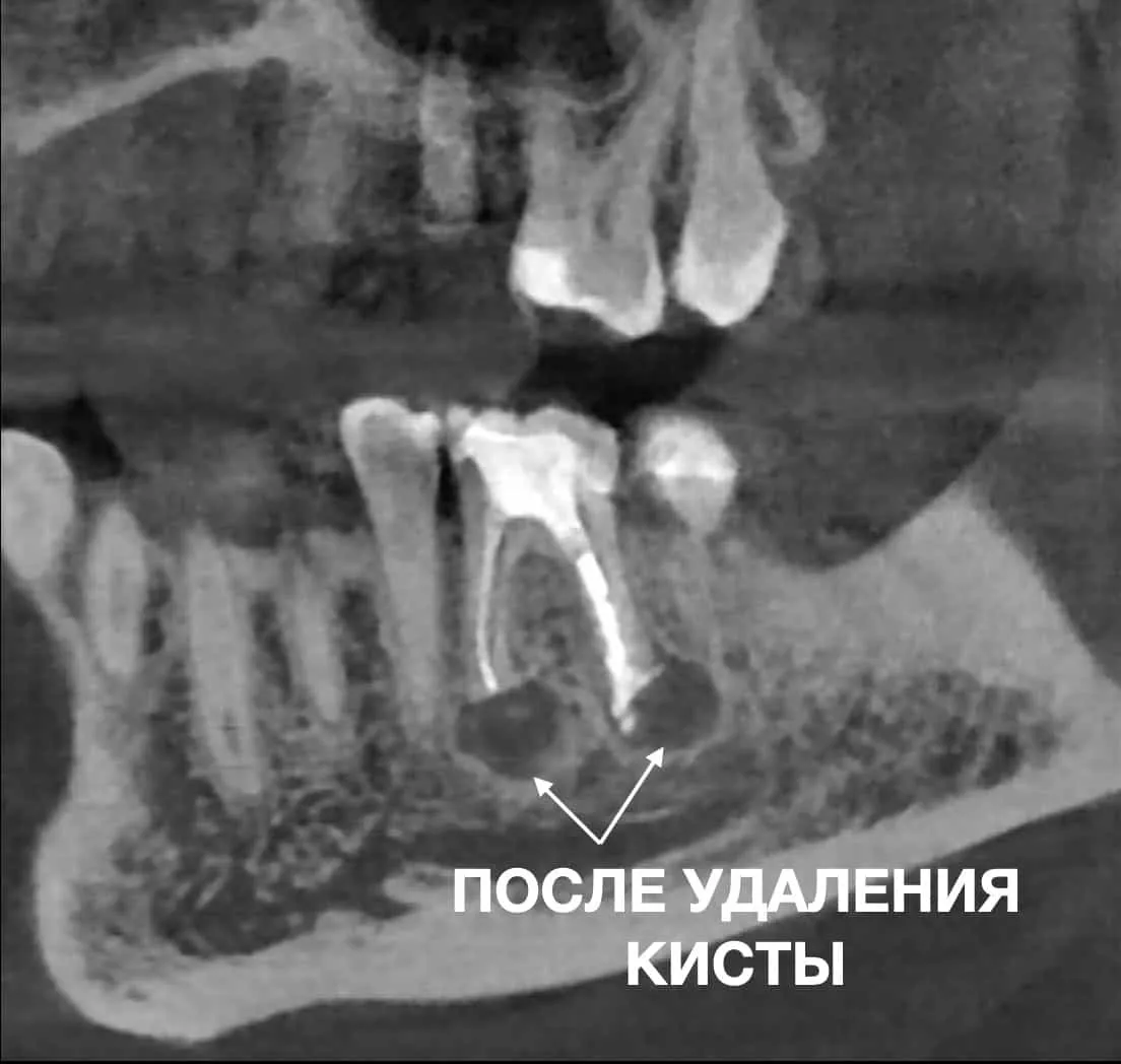 Лечение корневых каналов зубов под микроскопом