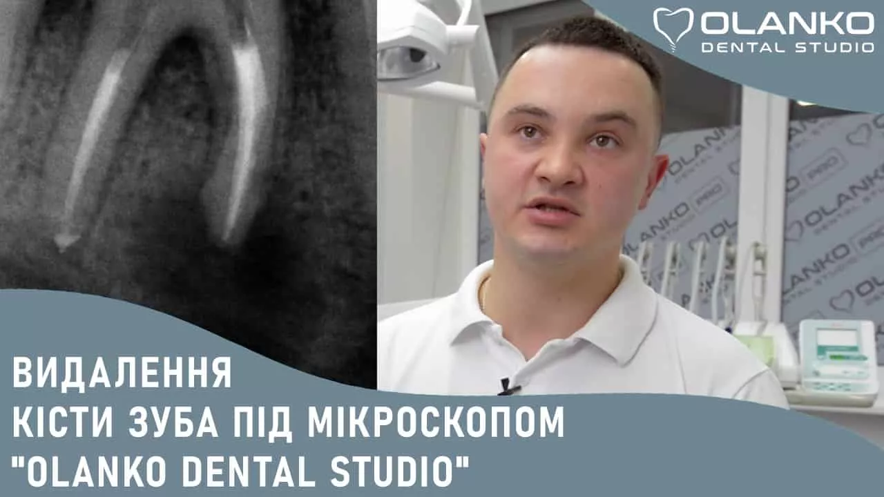 Лечение корневых каналов зубов под микроскопом