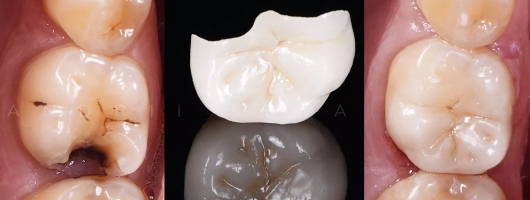 Фото керамической вкладки, до и после