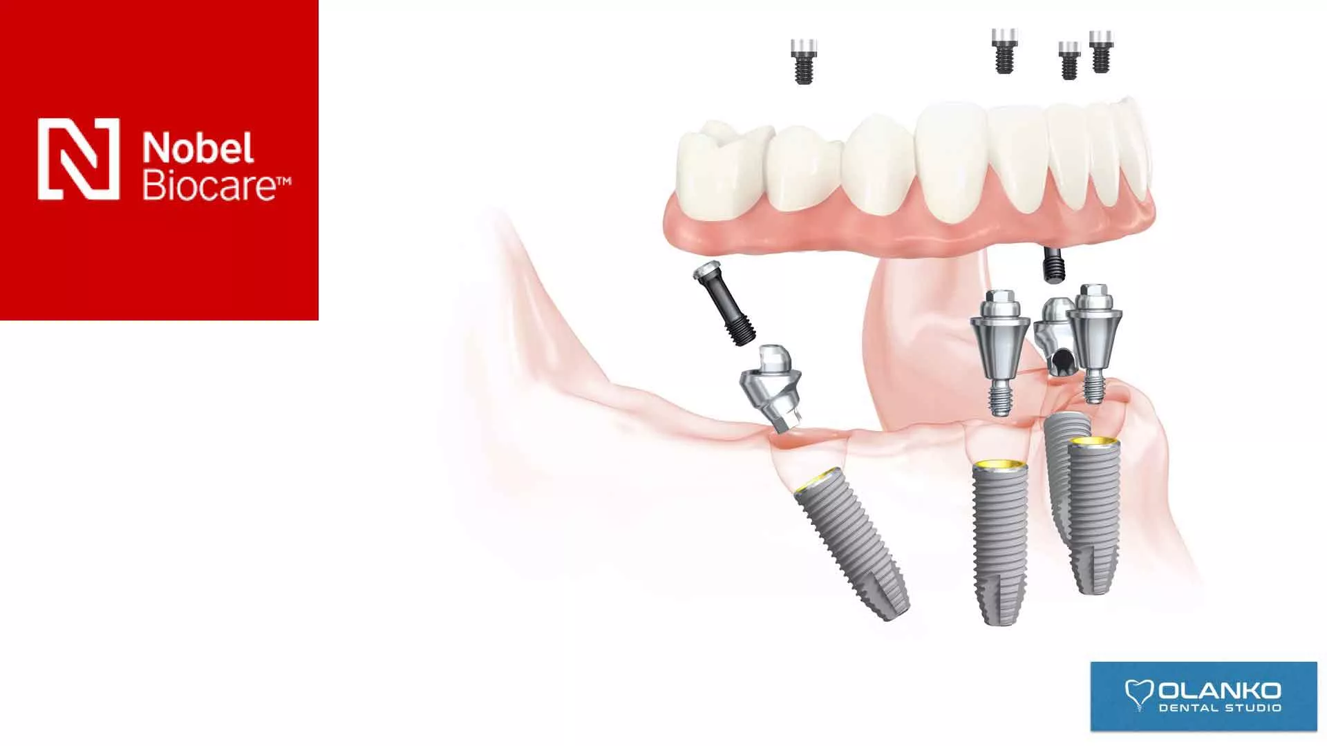 Импланты Nobel система номер 1 в мире