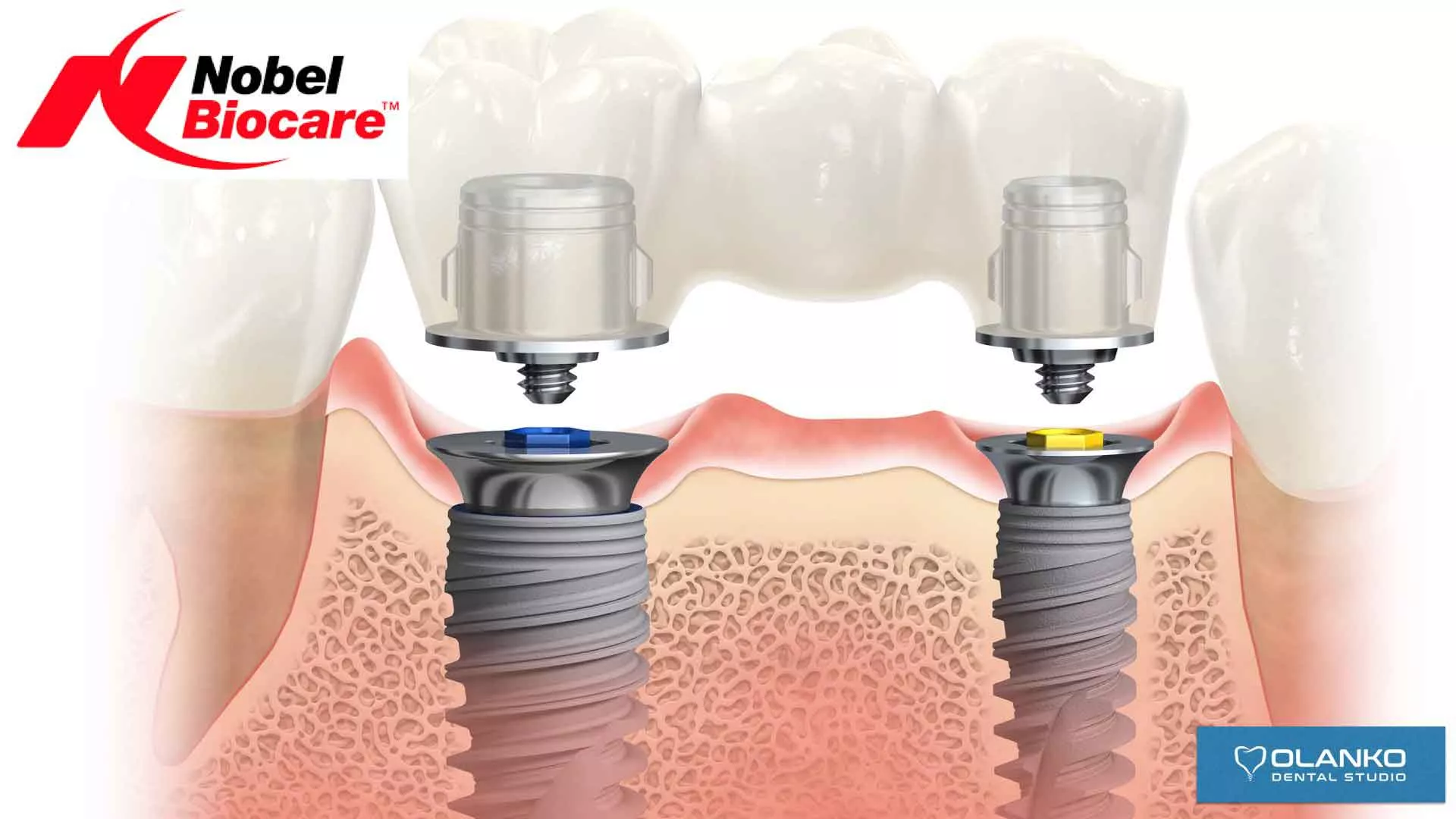 Импланты Nobel система номер 1 в мире