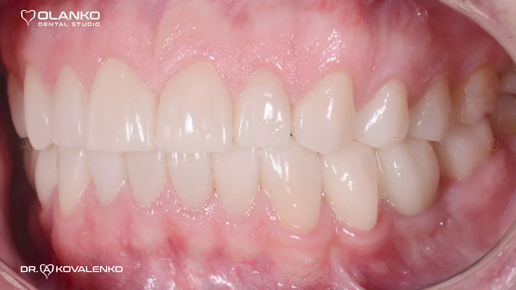 Протезирование зубов имплантами после Оланко Бровары Киев