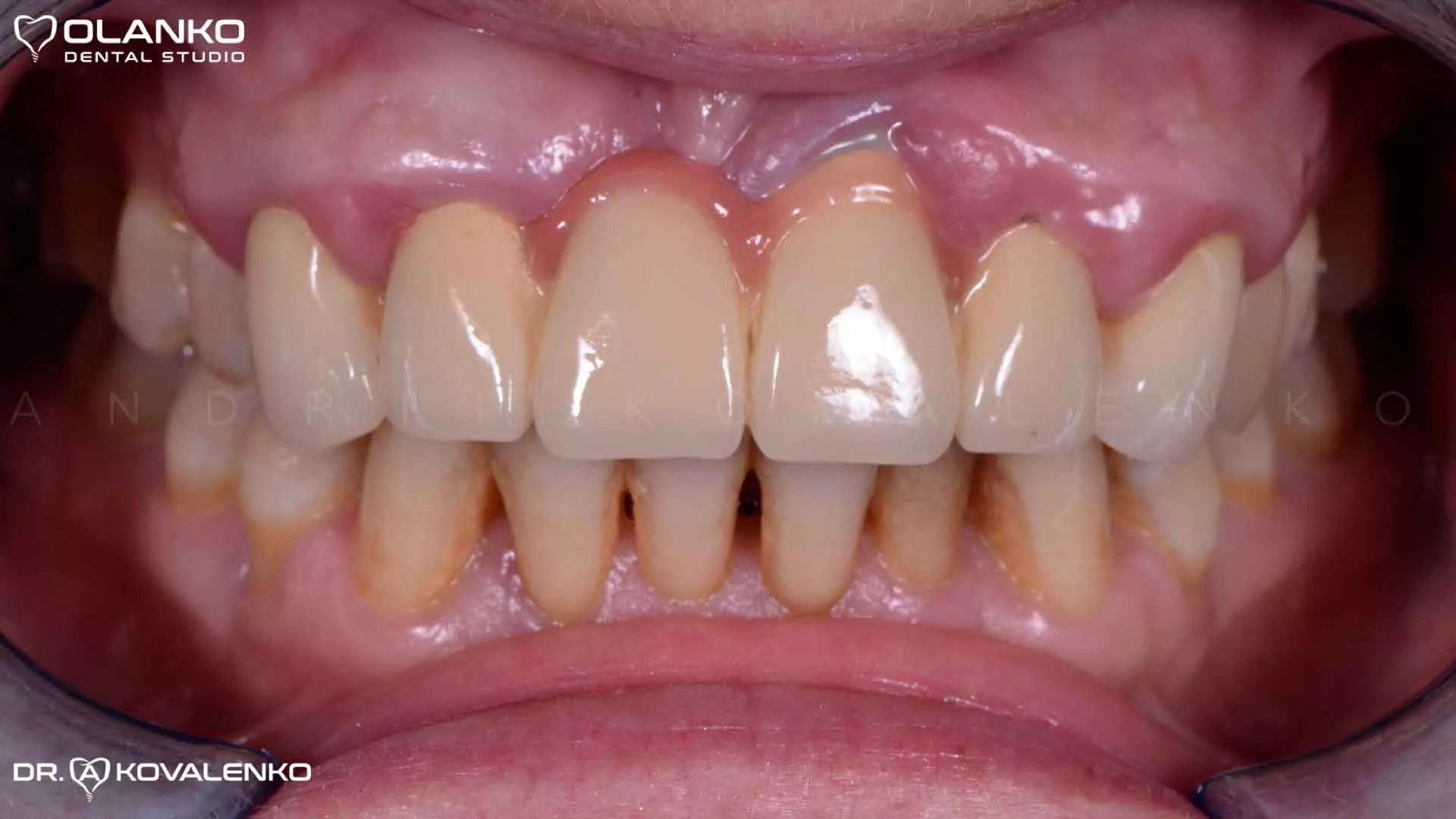 Клинический случай 8 имплантация зубов