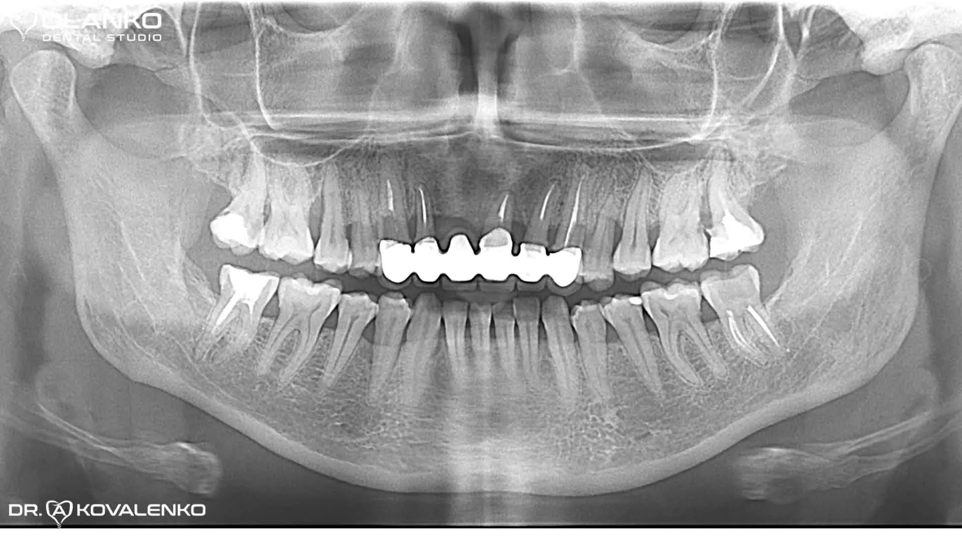 Клинический случай 8 имплантация зубов