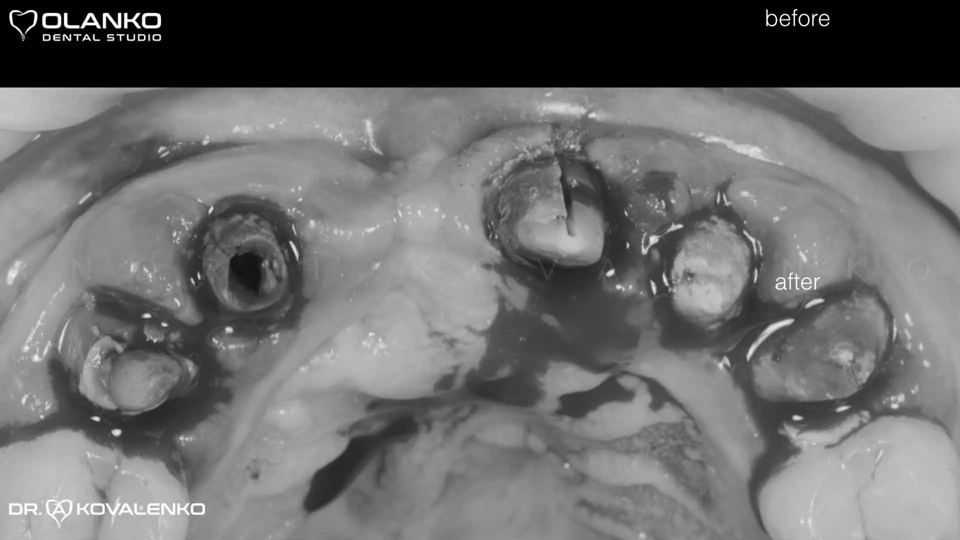 Клинический случай 8 имплантация зубов