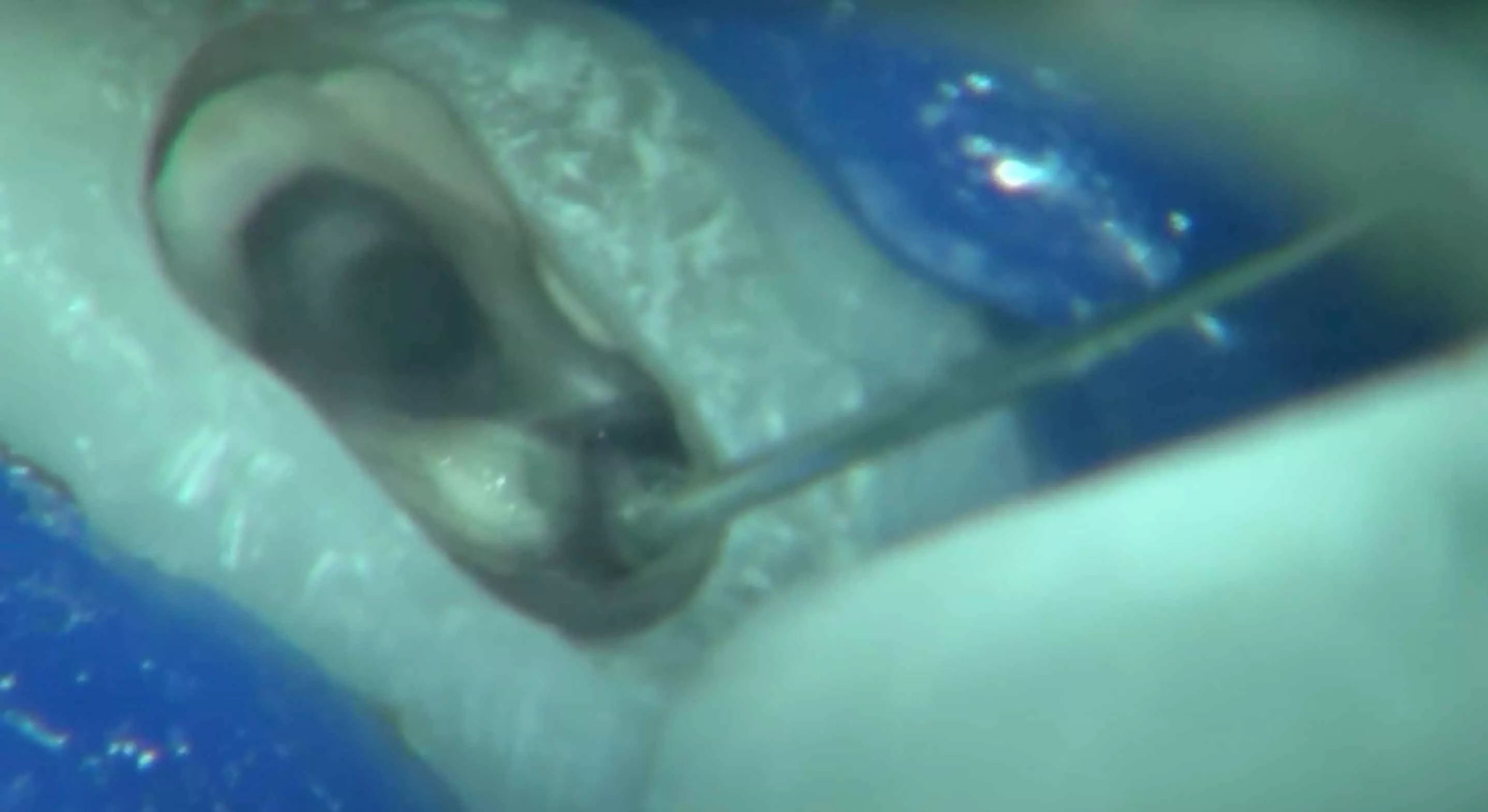 Лечение корневых каналов зубов под микроскопом