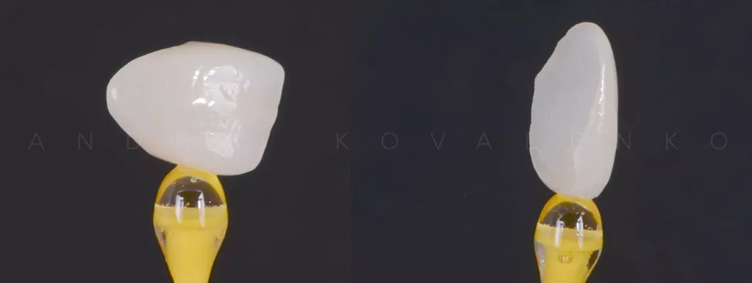 Виниры на зубы цена Киев Бровары Оланко