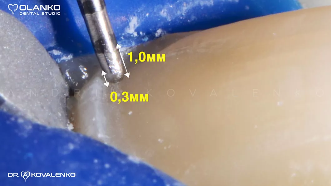 Сошлифовка под винир