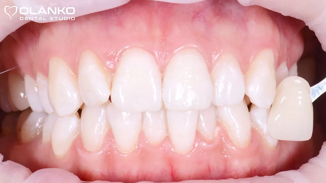 Аппаратное отбеливание зубов системой Magic Light (до) Отбеливание зубов цена Бровары Киев