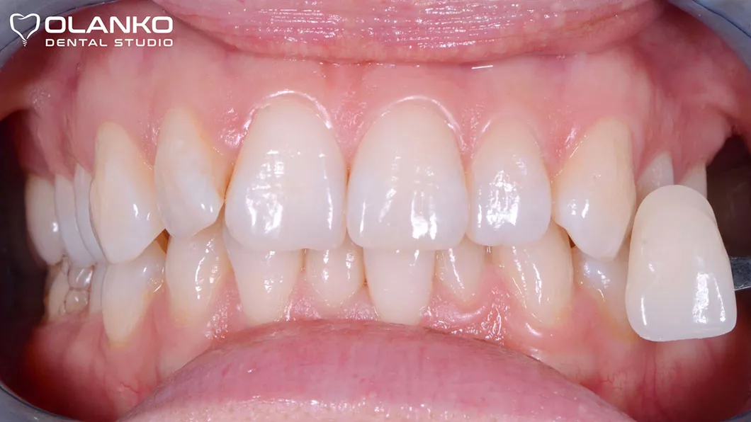 Аппаратное отбеливание зубов системой Magic Light (после) Отбеливание зубов цена Бровары Киев