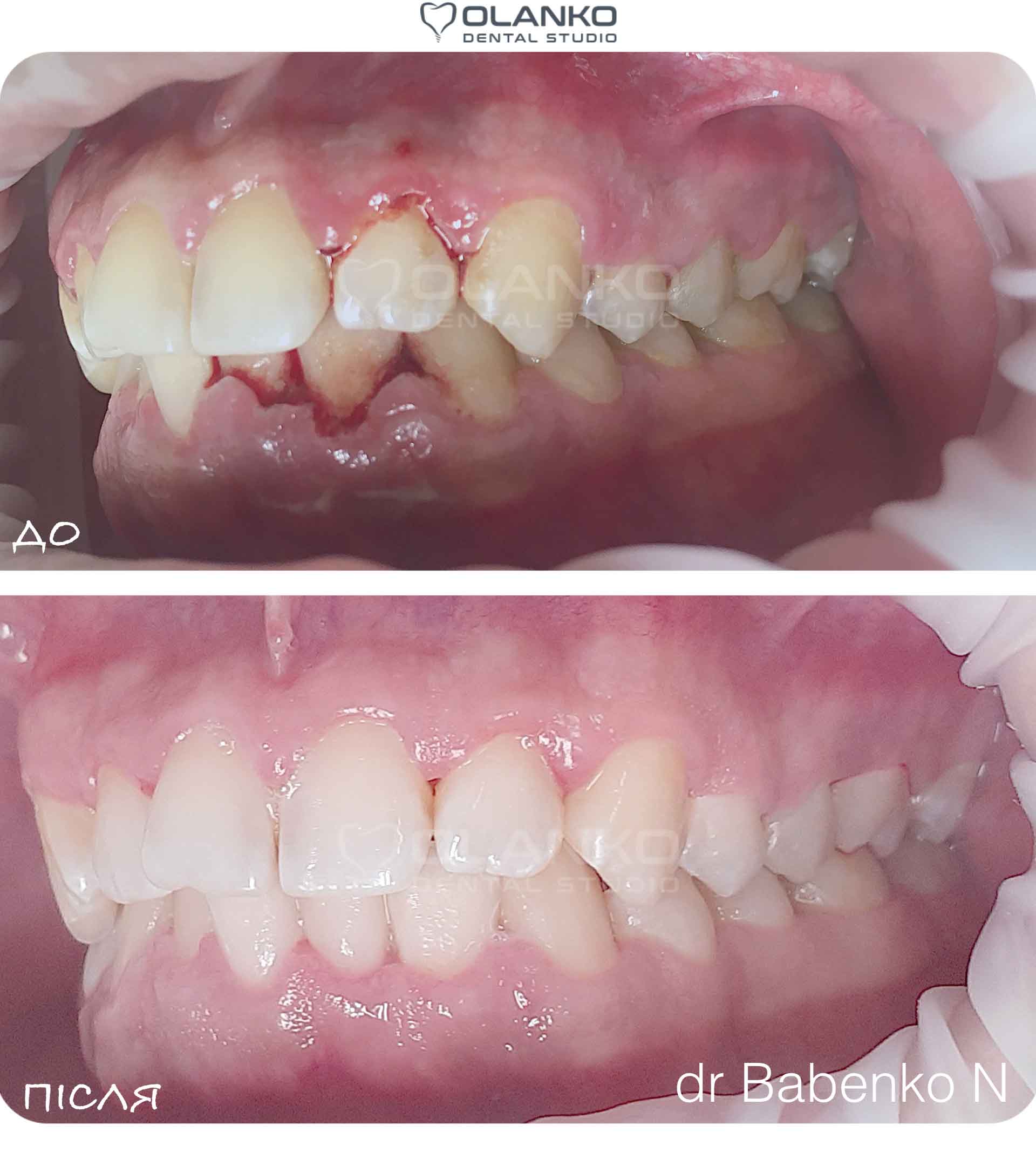 Лечение воспаления десён, пародонтоза и пародонтита | Оланко Бровары Киев