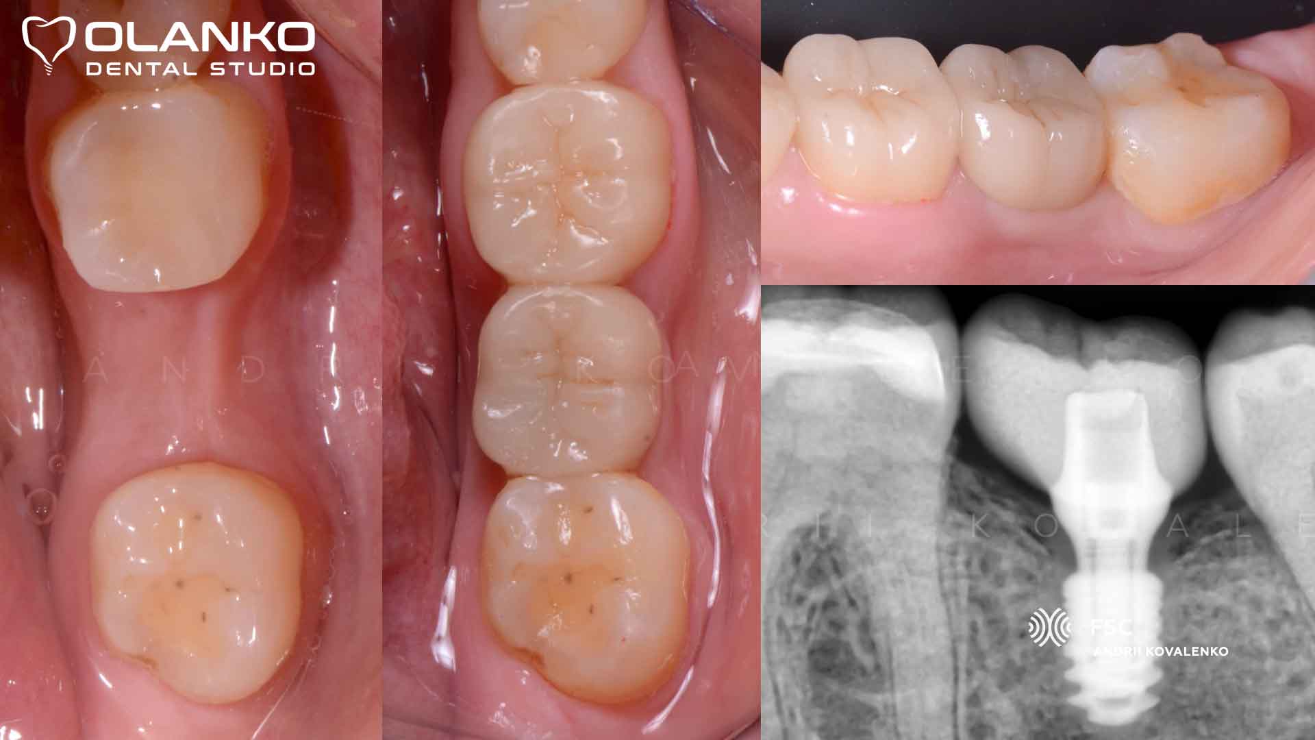 Зубной мост или зубной имплант Стоматология Оланко™