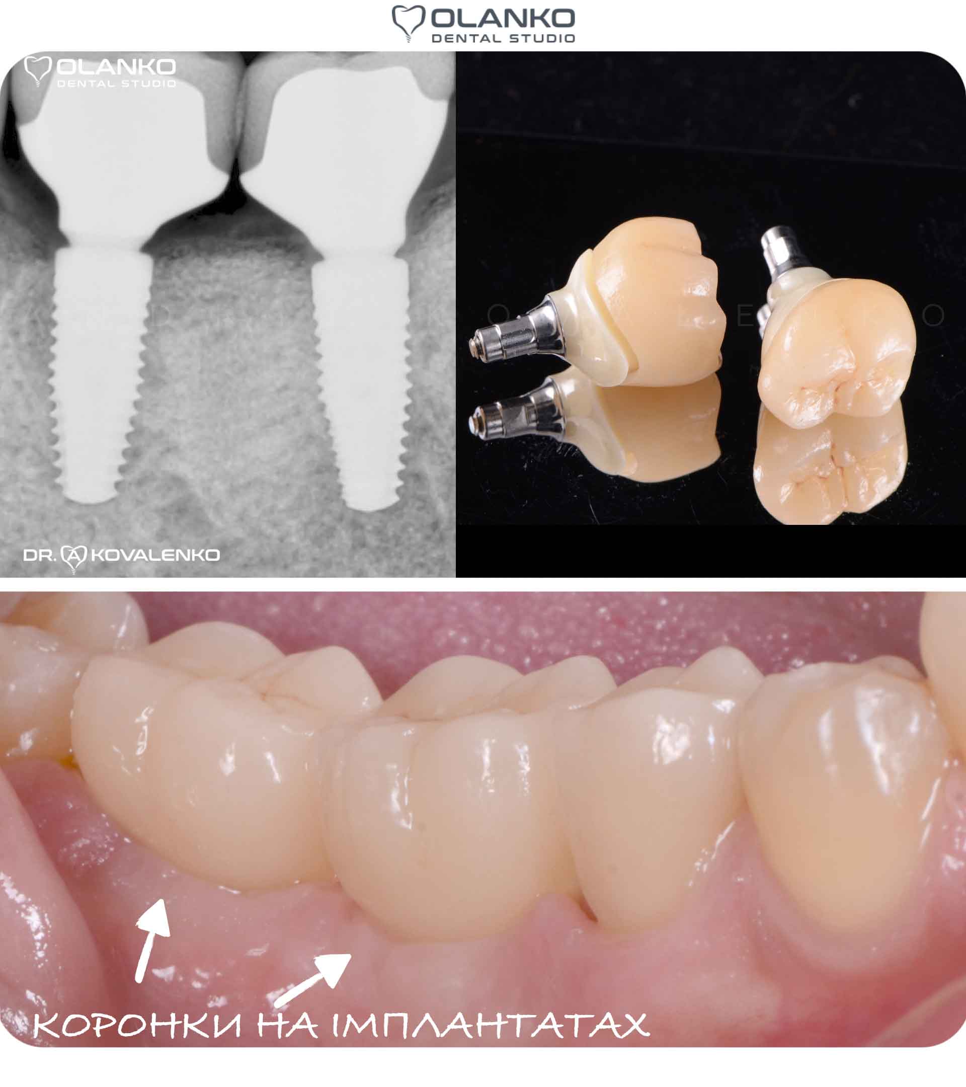 Фото пример работы по восстановлению двух жевательных зубов с помощью имплантов Штрауманн 