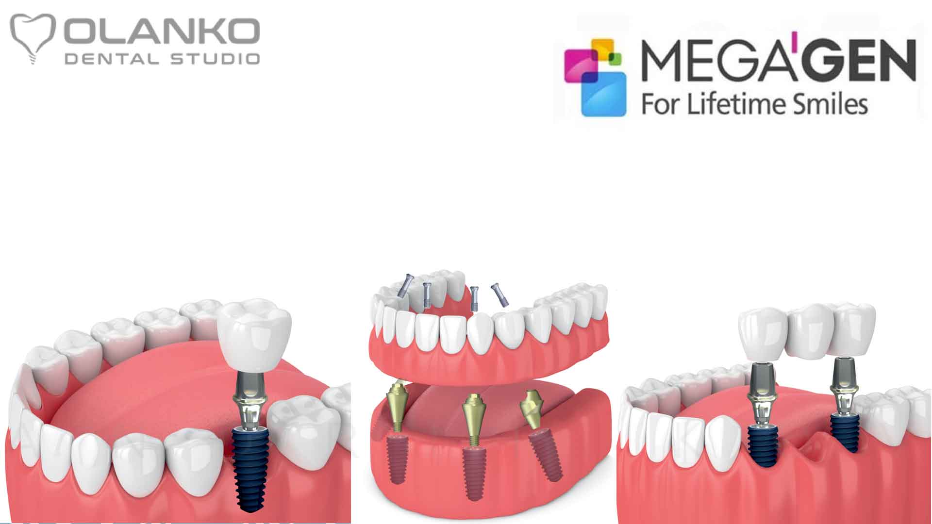 Система зубных имплантатов MegaGen производства Южная Корея | Оланко