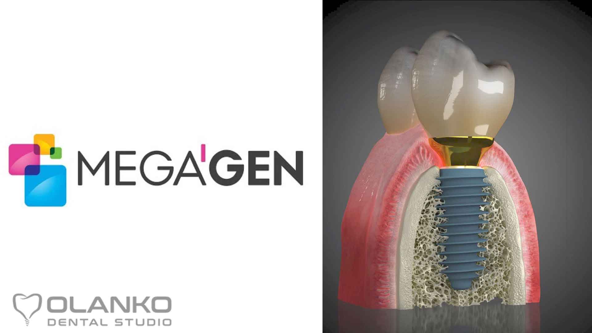 Система зубных имплантатов MegaGen производства Южная Корея | Оланко