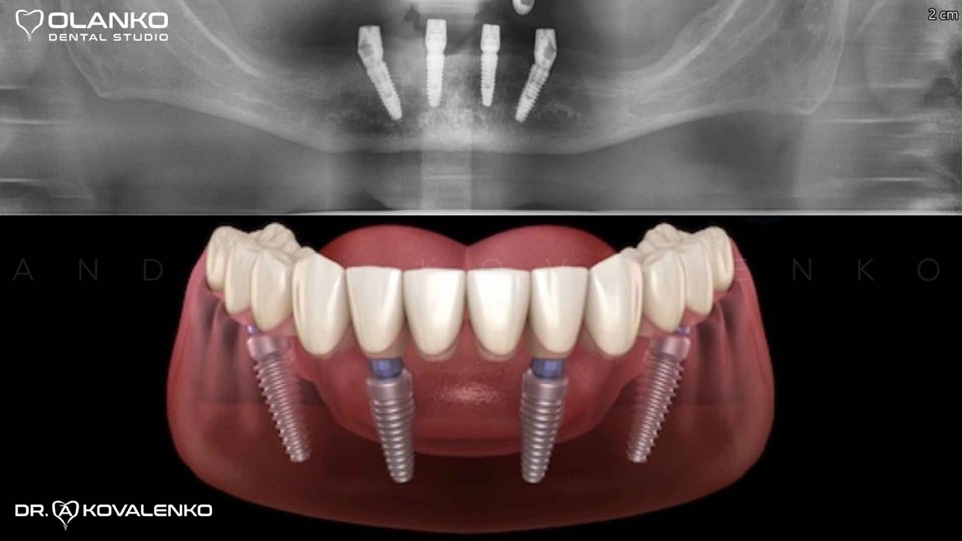 Фото пример работы по установке четырёх имплантатов на нижней челюсти Оланко Бровары Киев