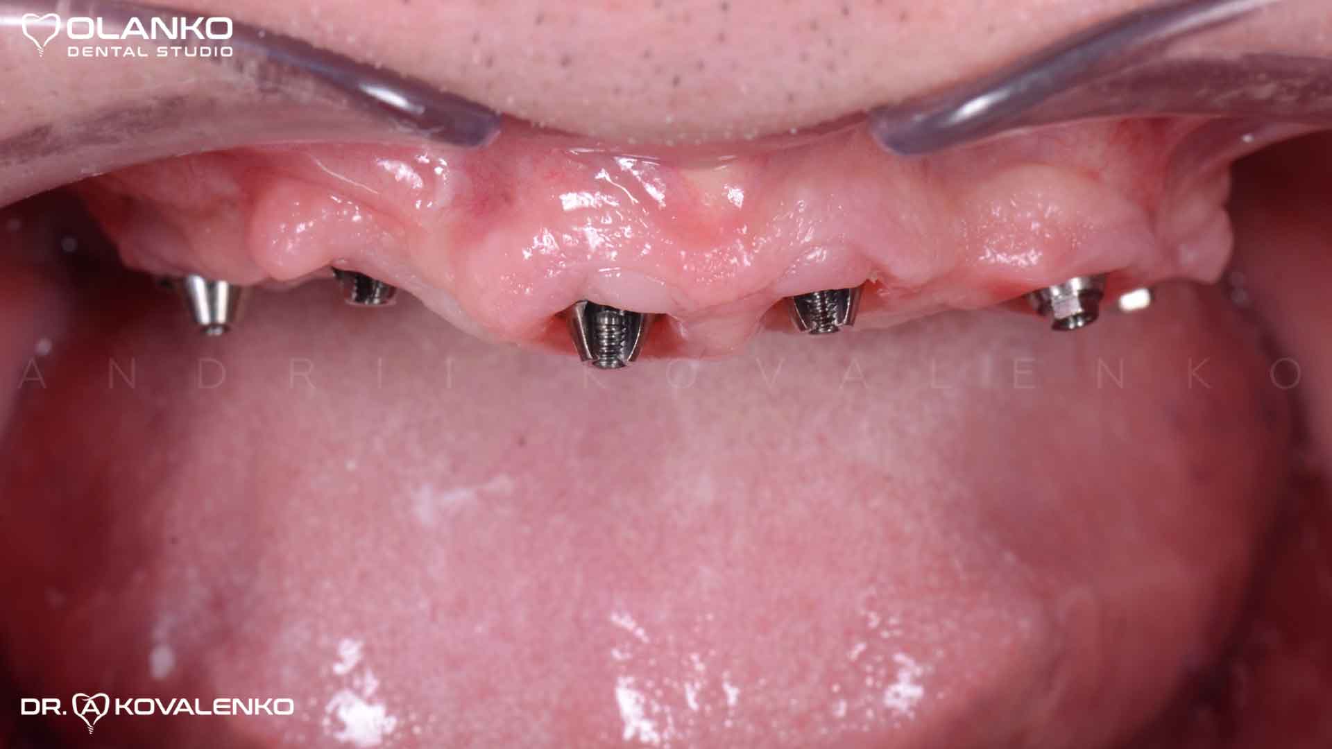 Имплантация при полном отсутствии зубов Стоматология - Оланко Бровары Киев