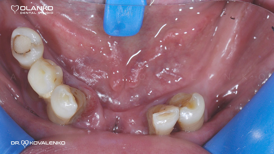 Клинический случай 1 имплантация зубов