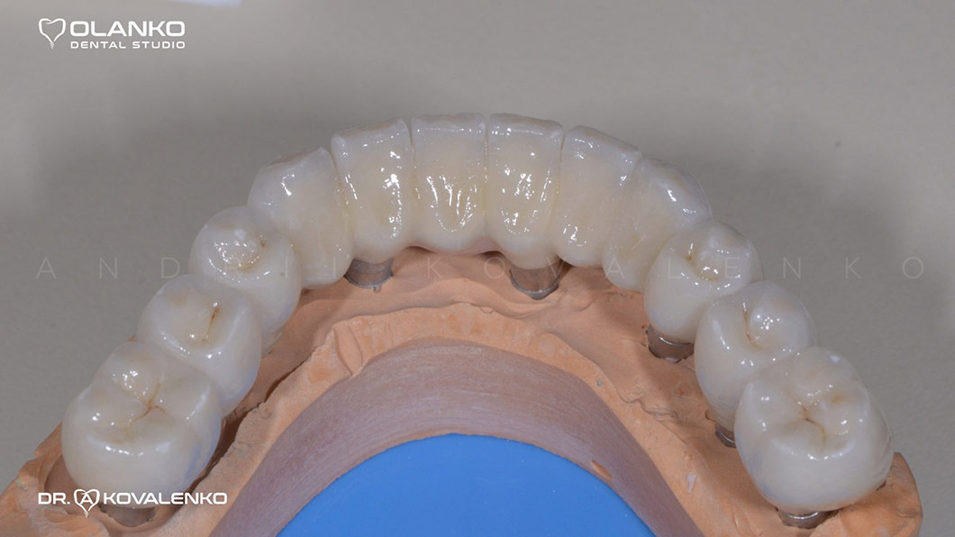 Клинический случай 1 имплантация зубов