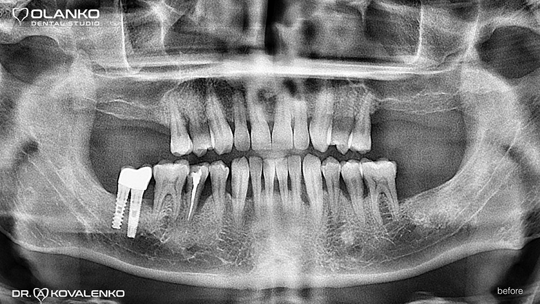 Клинический случай 2 имплантация зубов