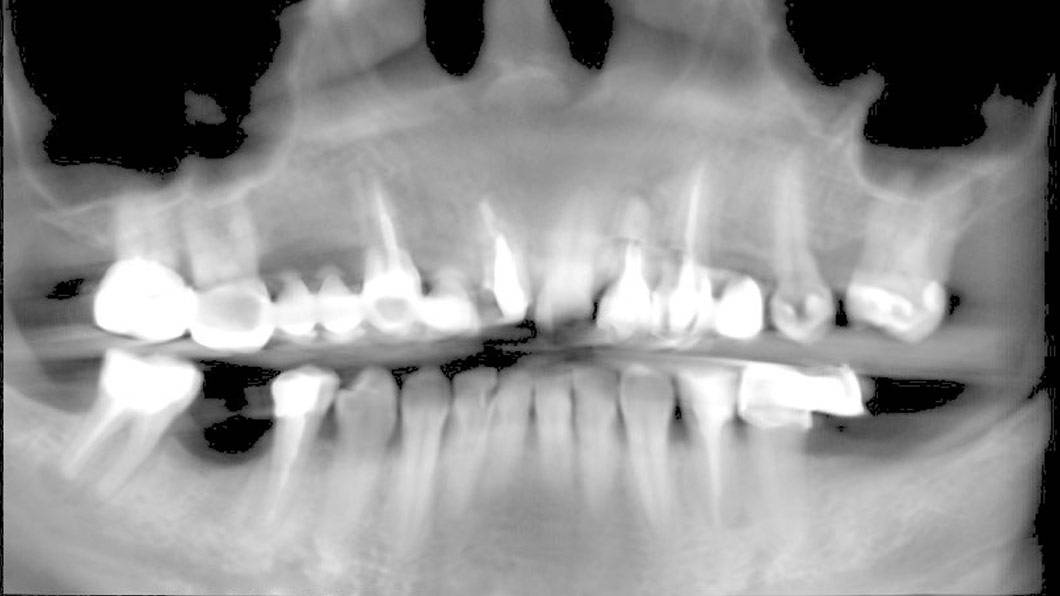 Клинический случай 3 имплантация зубов