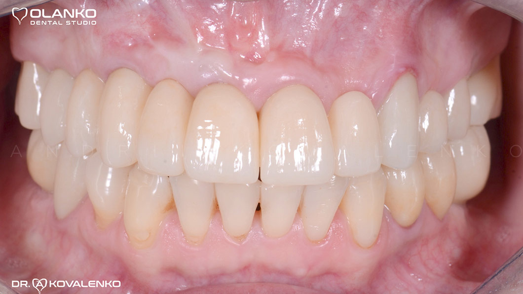 Клинический случай 3 имплантация зубов