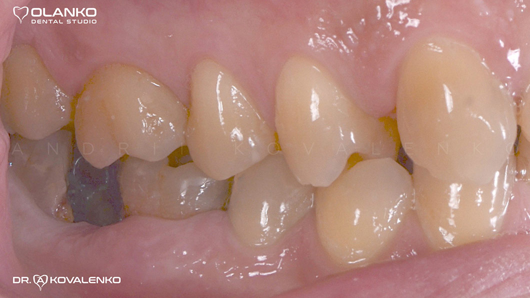 Клинический случай 4 имплантация зубов