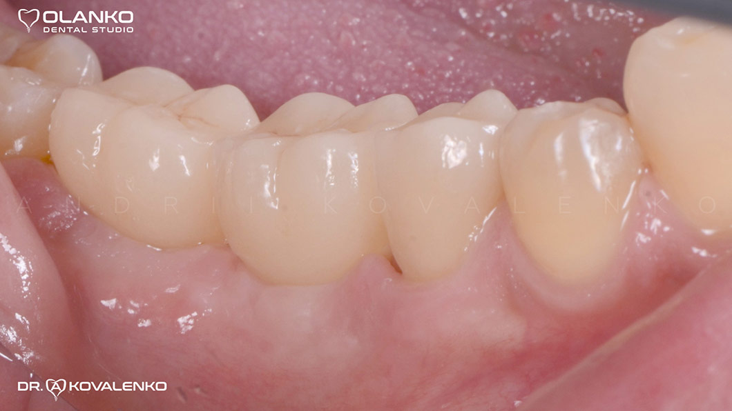 Клинический случай 4 имплантация зубов