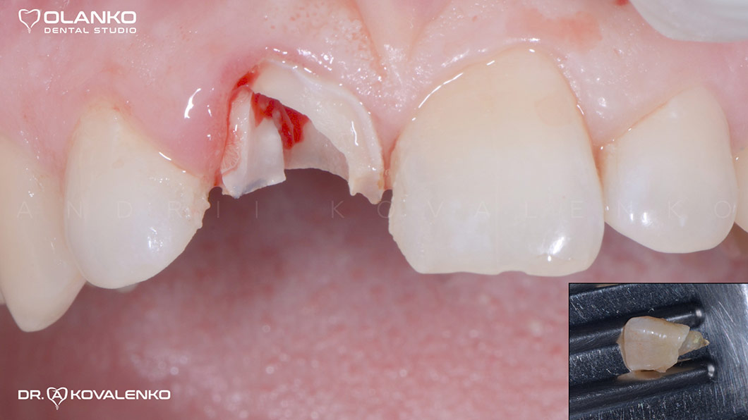 Клинический случай 5 имплантация зубов