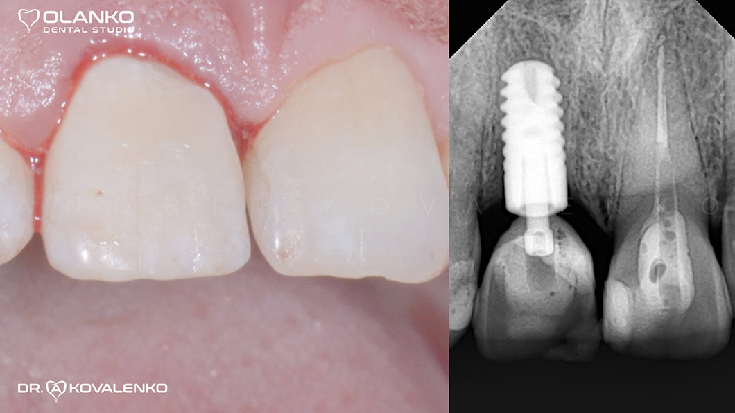 Клинический случай 5 имплантация зубов