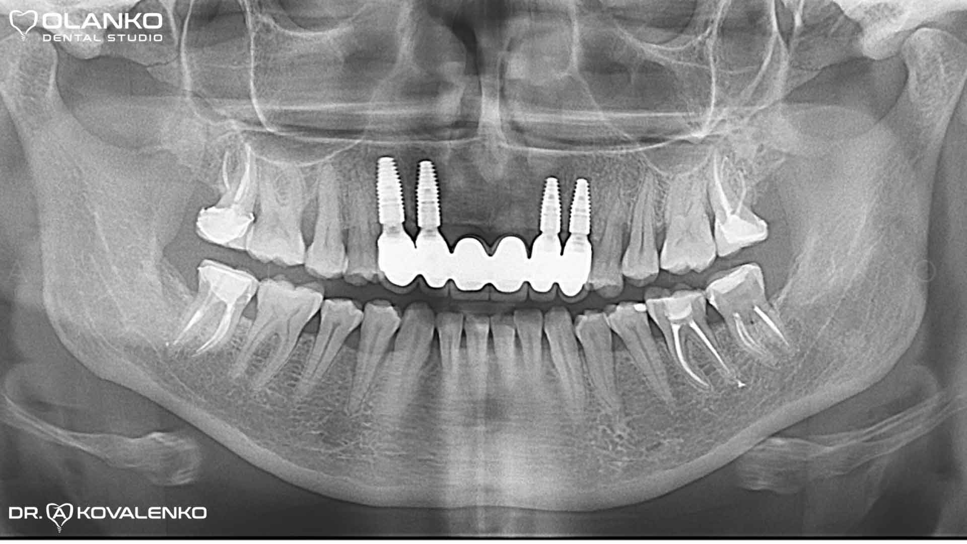 Клинический случай 8 имплантация зубов