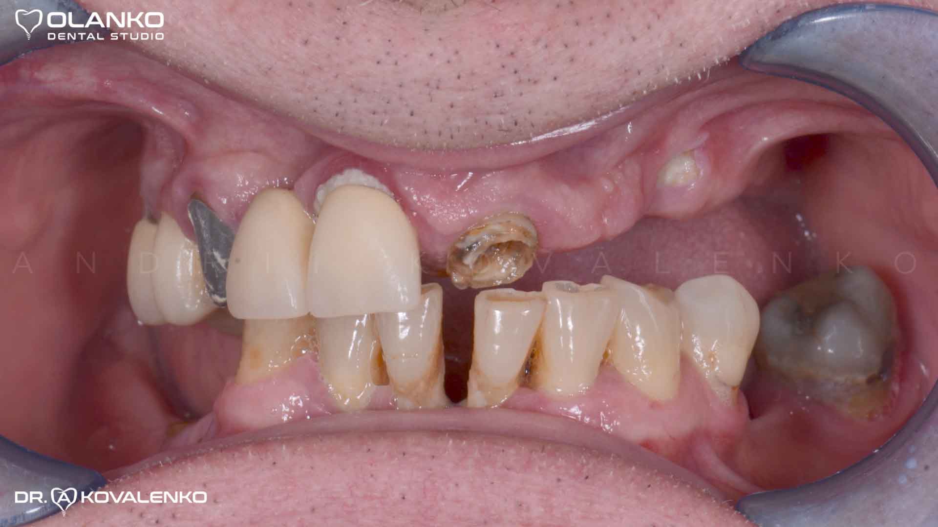 Клинический случай 7 имплантация зубов