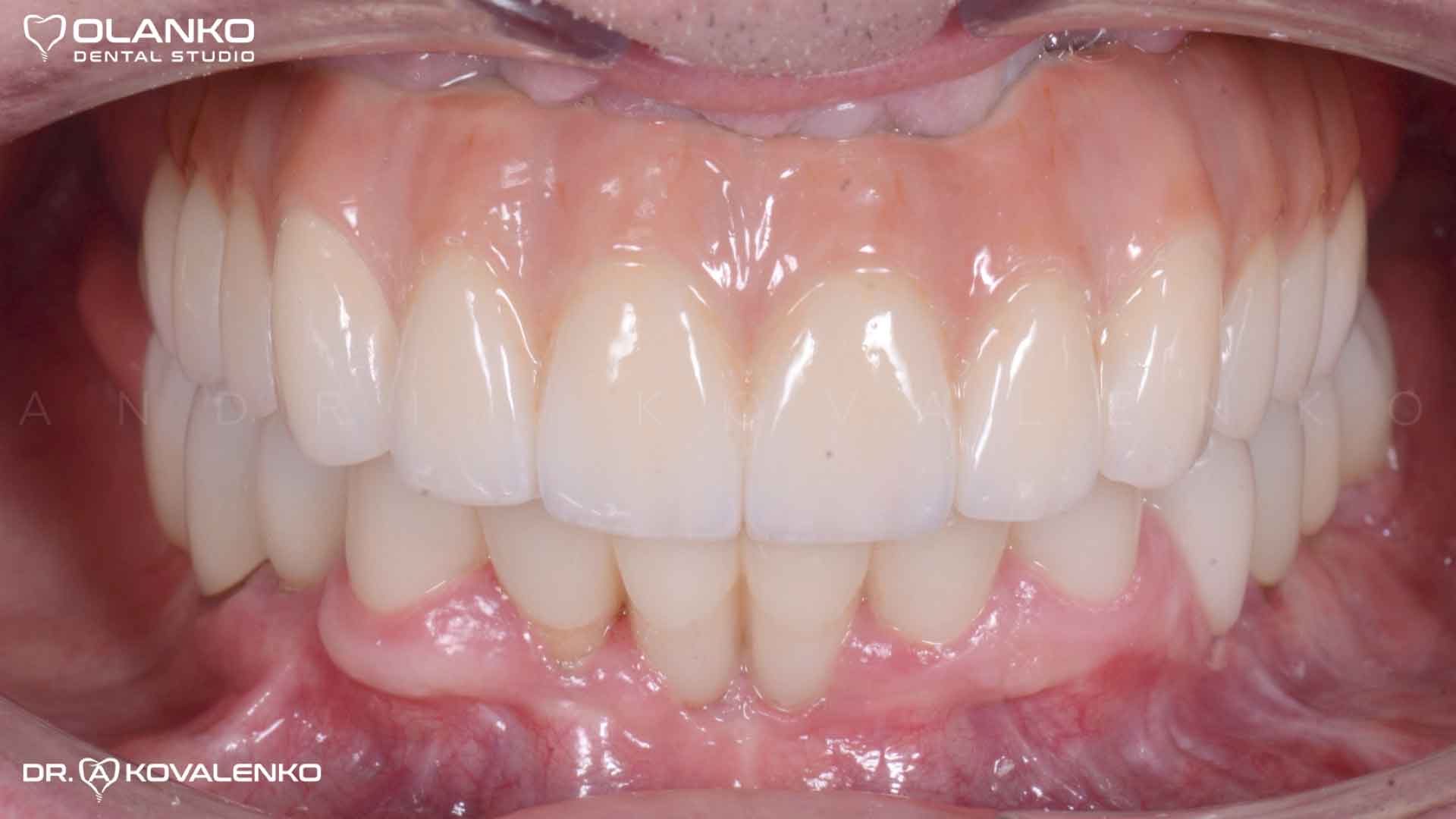 Клинический случай 7 имплантация зубов