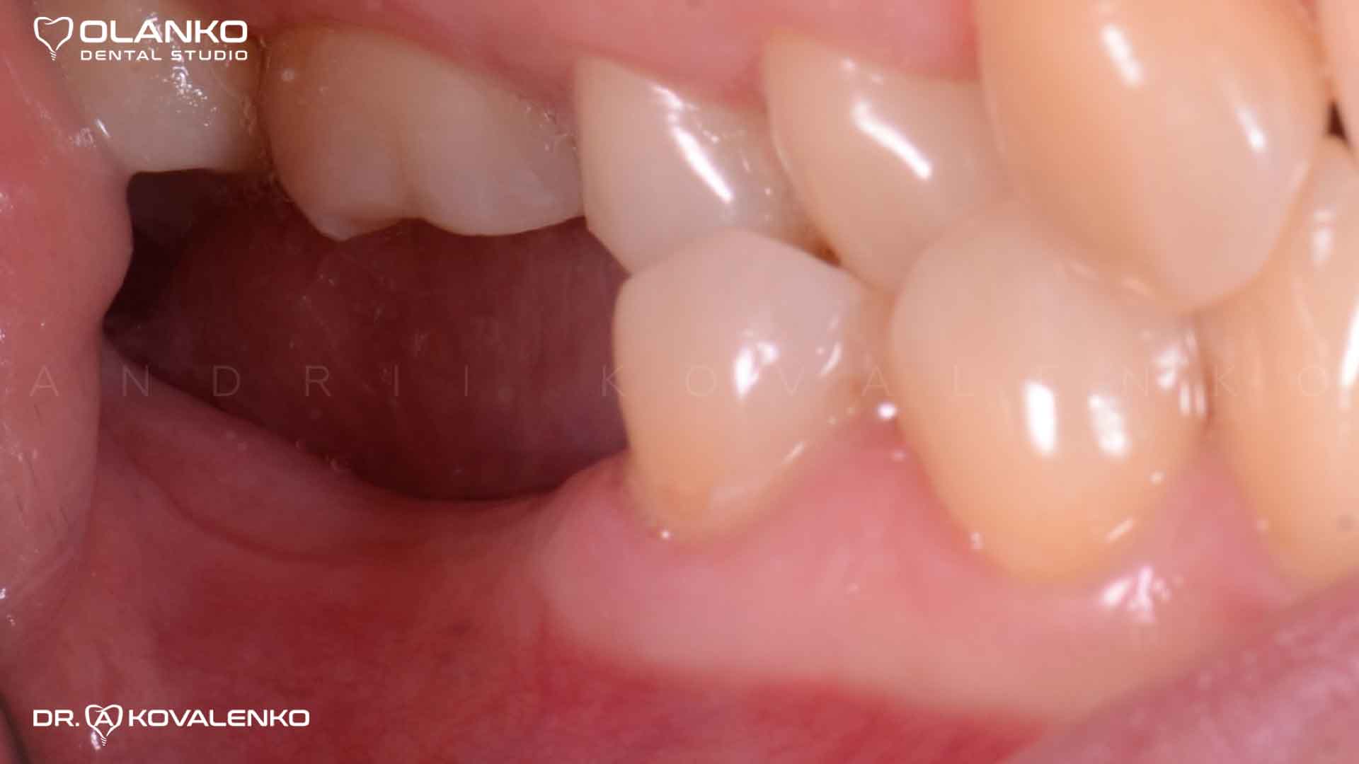Клинический случай 6 имплантация зубов